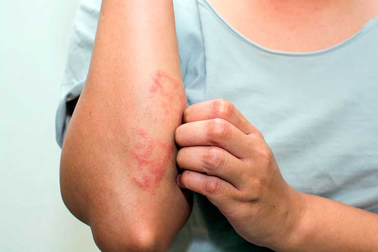 Eczema flare-up