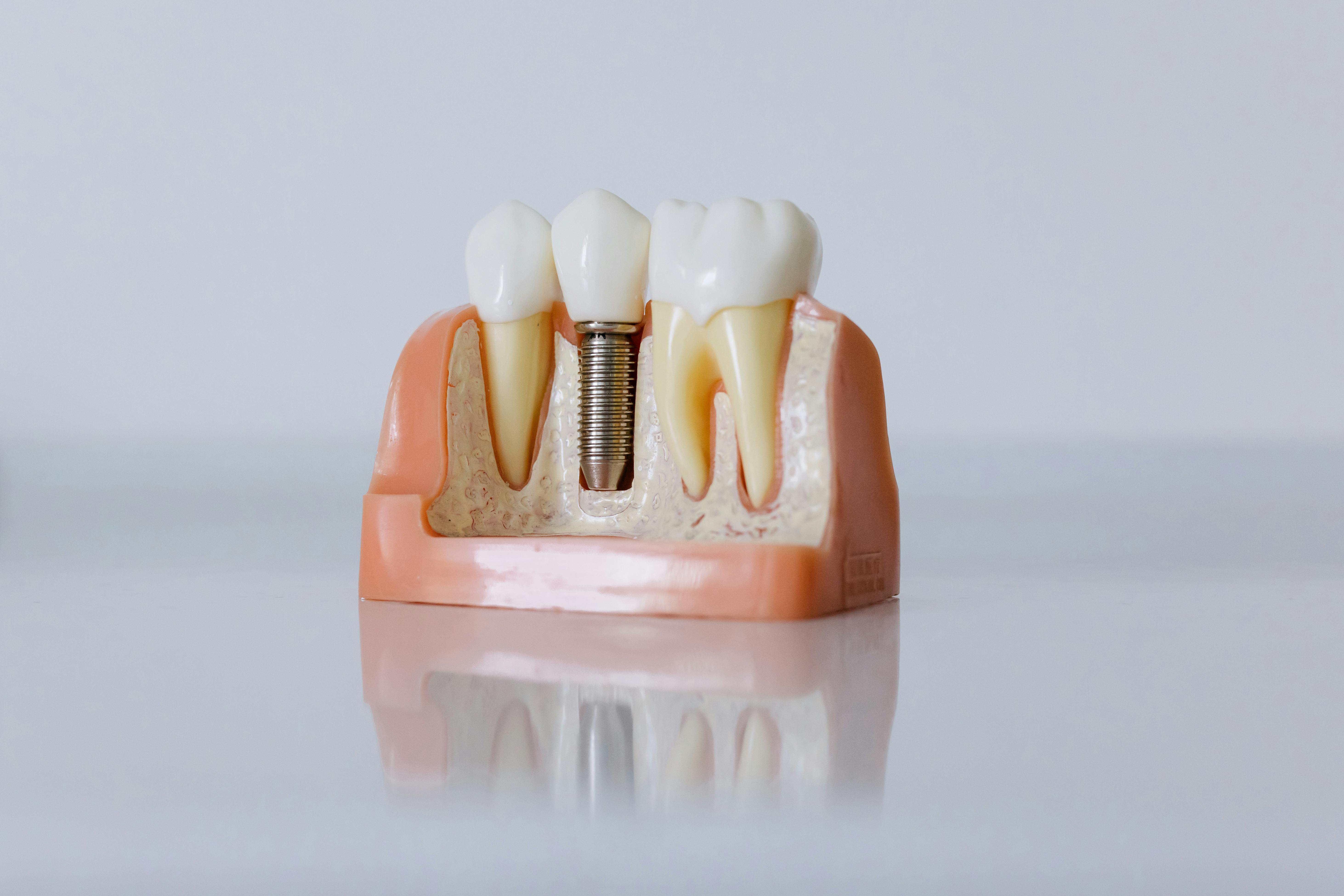 Which Are the Best Clinics in Barnet for Long-Lasting Dental Implants?
